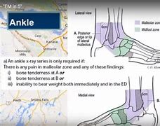 Image result for Ottawa Knee