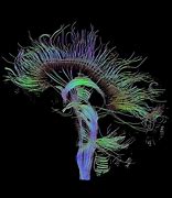 Image result for Diffusion MRI