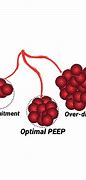 Image result for Peep COPD