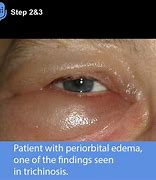 Image result for Trichiniasis