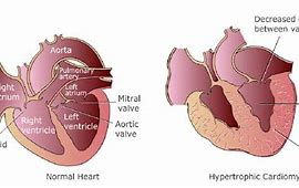 Image result for High Blood Pressure and Heart Disease