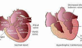 Image result for High Blood Pressure Cardiovascular Disease