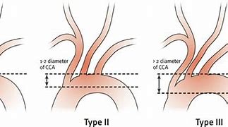 Image result for Aortic Vessels