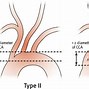 Image result for Aortic Vessels