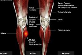 Image result for Tear in Calf Muscle