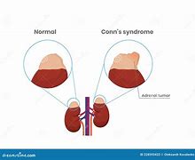 Image result for Adrenal Gland Adenoma