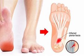 Image result for Plantar Fascia Ligament Pain