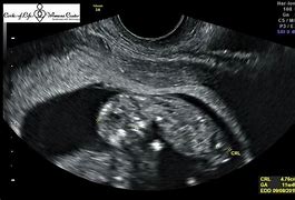 Image result for 3 Month Pregnancy Ultrasound