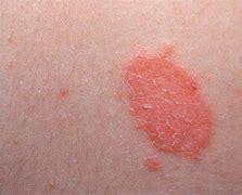 Image result for Scaly Rash