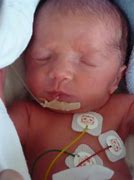 Image result for Baby Einblutung Bein