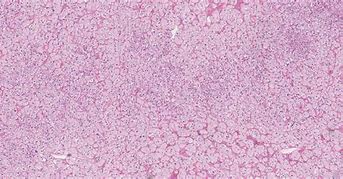 Image result for Adrenal Gland Adenoma