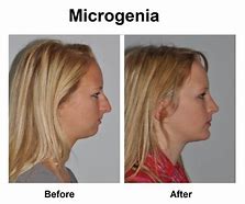 Image result for Microgenia