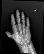 Image result for Dislocated Finger Joint