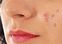 Image result for Swollen Face From Under the Skin Pimple