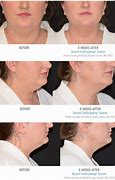 Image result for CoolSculpting Chin Before and After