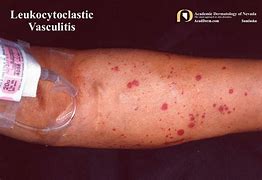 Image result for Vasculitis Leg Ulcers