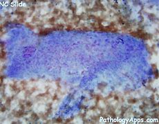 Image result for Adrenal Cytology