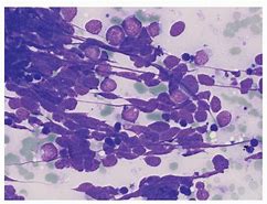 Image result for Adrenal Cytology