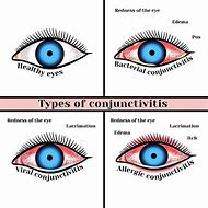 Image result for Symptoms of Eye Infection