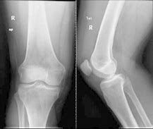 Image result for Normal Lateral Knee Radiograph