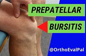 Image result for Sasd Bursitis