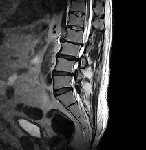 Image result for Lumbar Spine MRI 8Mm