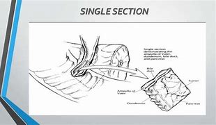 Image result for Whipple Specimen Gross Pathology