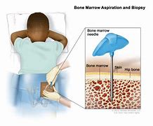 Image result for Medulloblastoma in Child