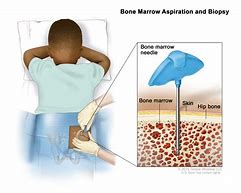 Image result for Neuropil Medulloblastoma