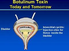 Image result for Botox Needle Bladder