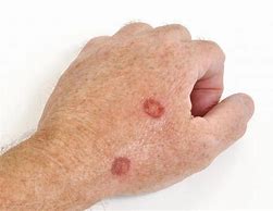 Image result for Skin Cancer On Back of Hand