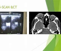 Image result for Orbital Hemorrhage CT