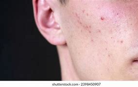 Image result for Pimple Face Wallpaper