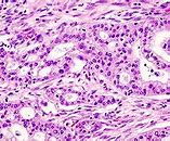 Image result for Pancreatic Adenocarcinoma