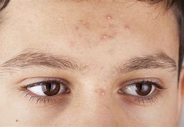 Image result for Pustule Rashes