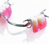 Image result for Metal-Based Partial Dentures