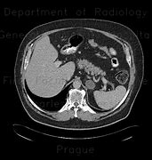 Image result for Adrenal Gland Adenoma