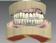 Image result for CAD/CAM Dentures