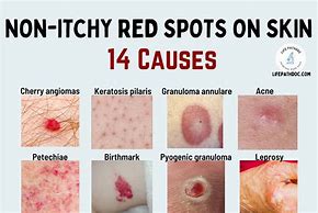 Image result for Red Flat Skin Lesion