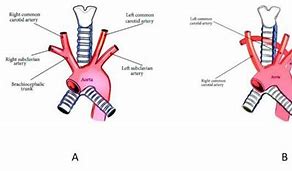 Image result for Retrocaval Artery