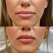 Image result for Versa Lip Filler