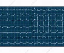 Image result for Myocarditis EKG Finding