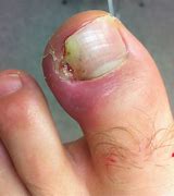 Image result for Ingrown Nail