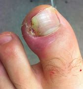 Image result for Ingrown Tools