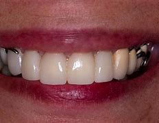 Image result for Upper Partial Dentures Pictures