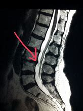 Image result for Lumbar Spine MRI 8Mm