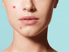 Image result for People with Pimples