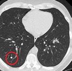 Image result for Lung Cancer On CT