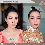 Image result for 1 Unit Chin Filler