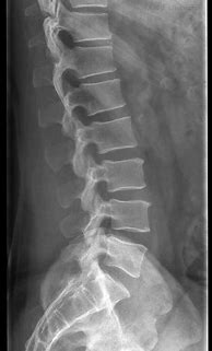 Image result for Lumbar Spine Side View